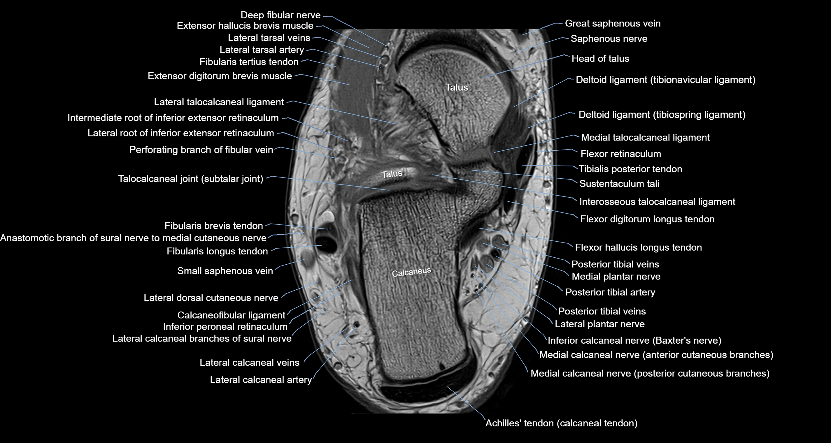 Ankle axial anatomy 3T MRI images -img-10001-00024.webp